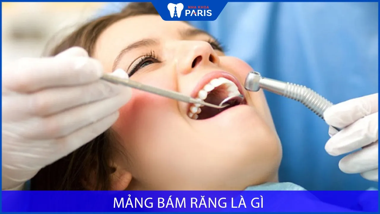Mảng bám răng là gì? Khác gì cao răng? Loại bỏ thế nào?