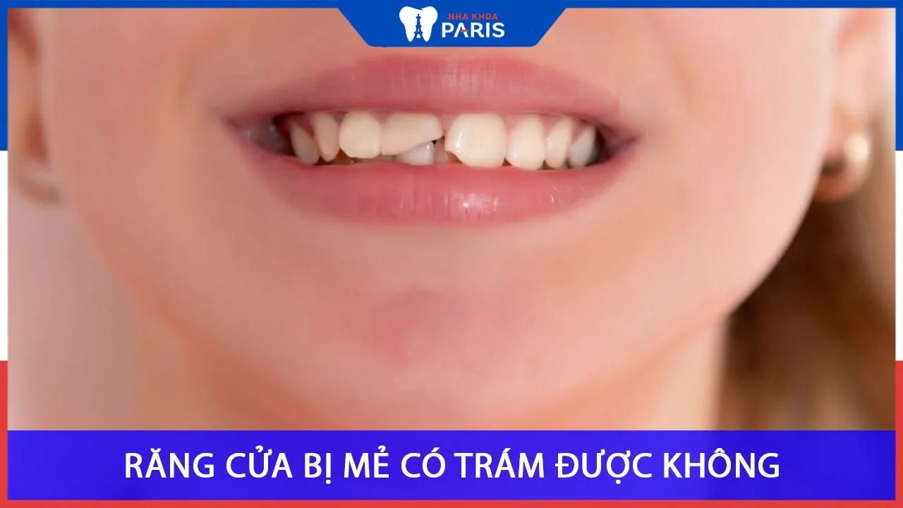 Cách trám răng cửa bị mẻ nhanh gọn tại Nha Khoa Paris