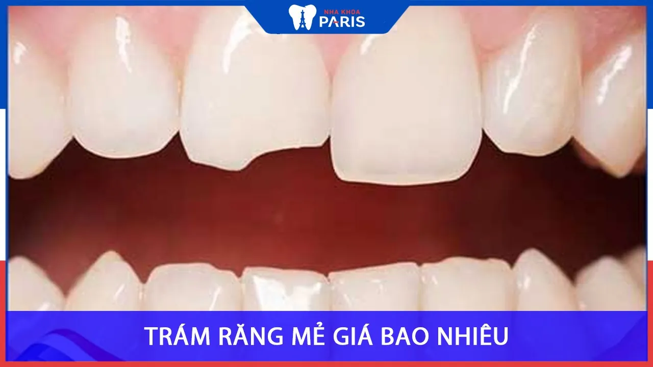 Trám răng MẺ giá bao nhiêu tiền? Các yếu tố ảnh hưởng tới chi phí