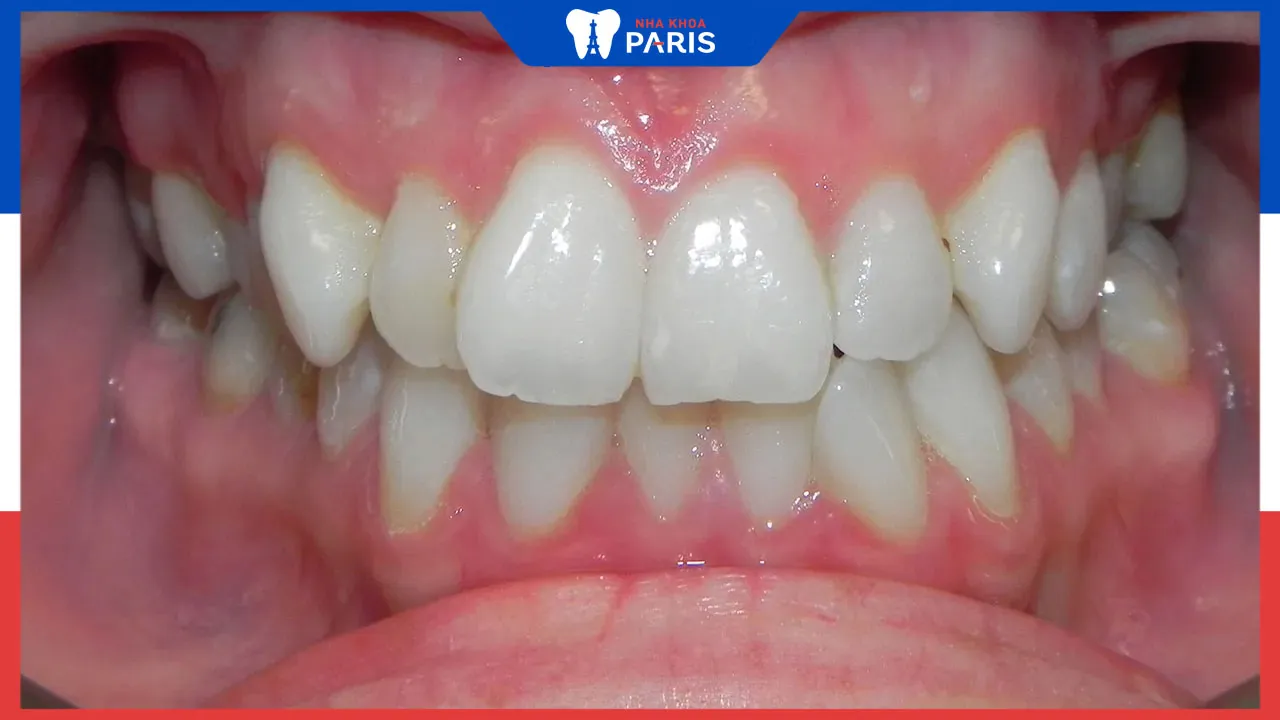 Tổng hợp những cách khắc phục khớp cắn sâu hiệu quả nhất