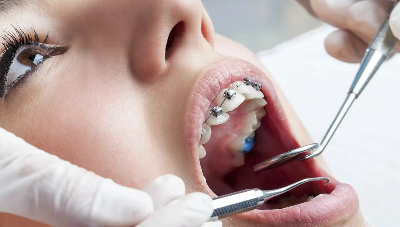 Niềng răng mất bao nhiêu tiền? Mẹo để niềng răng tiết kiệm