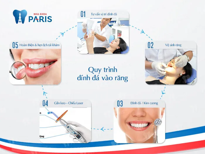 Ưu điểm công nghệ đính đá vào răng E.Las là gì?