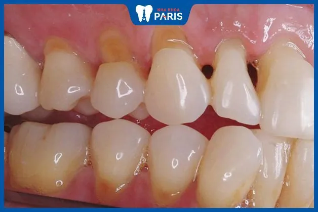 Bệnh mòn cổ chân răng là gì? Có nguy hiểm không? Cách chữa trị