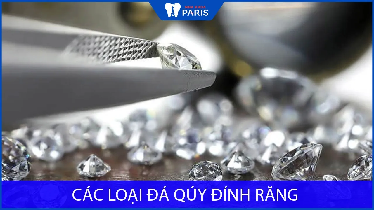 Các loại đá qúy đính răng được ưa chuộng nhất hiện nay