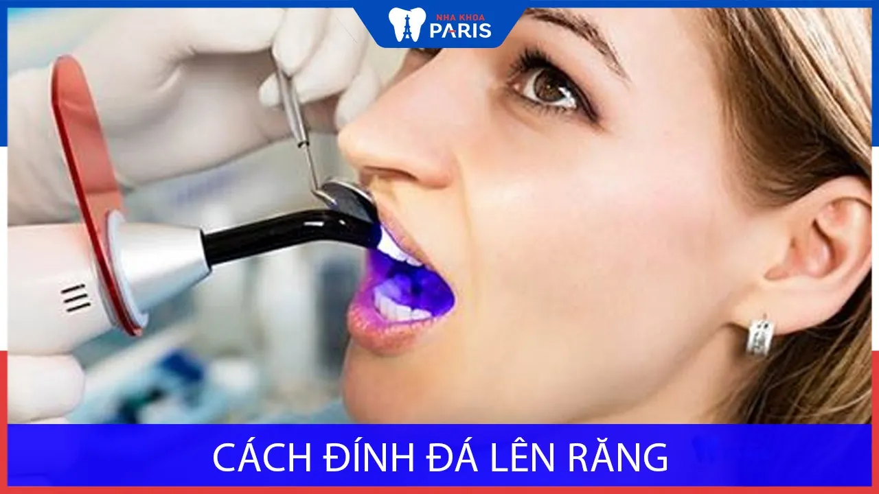 Cách đính đá lên răng tốt và hiệu quả nhất- Chuyên gia giải đáp