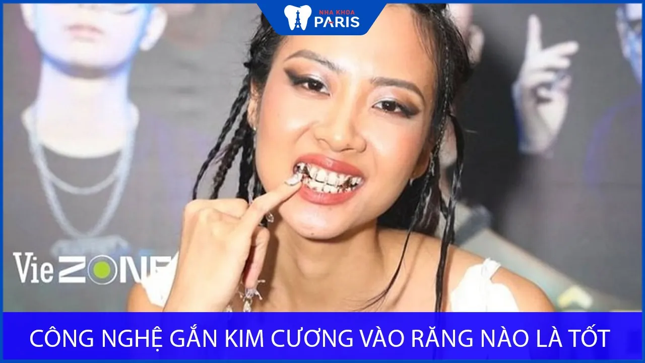 Công nghệ gắn kim cương vào răng nào là tốt nhất?