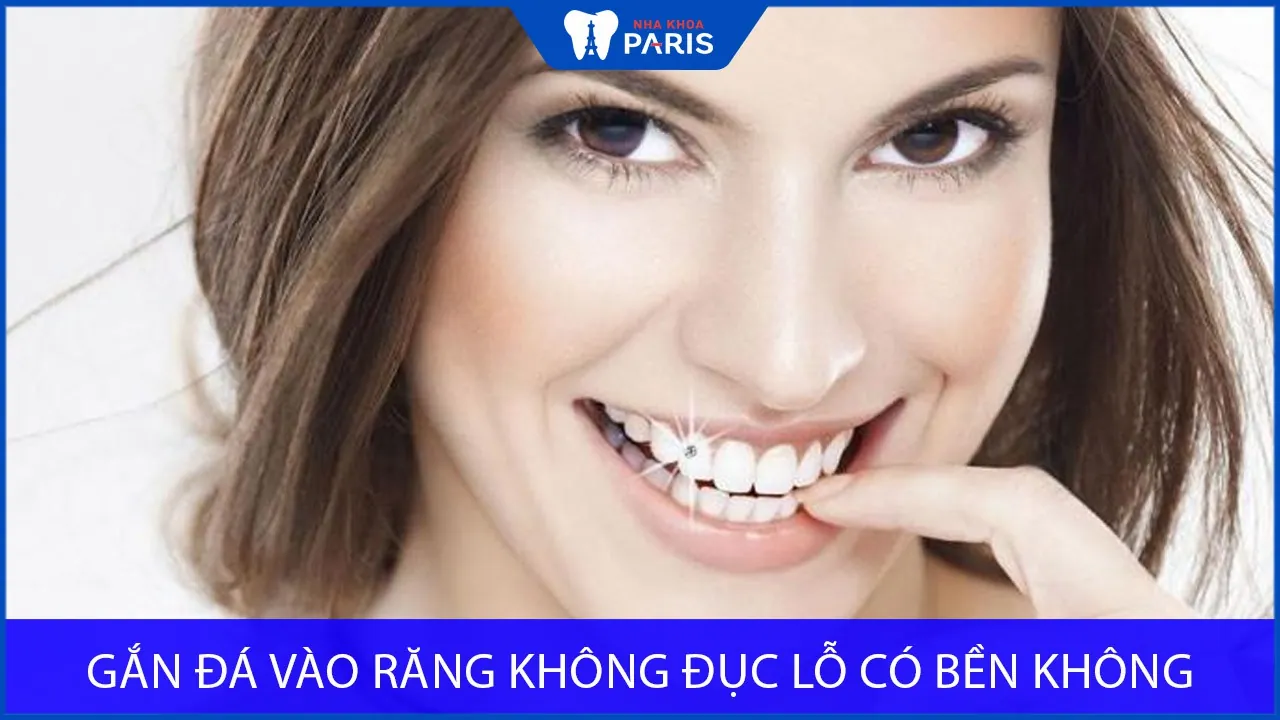 Giải đáp: Gắn đá vào răng không đục lỗ có bền không?