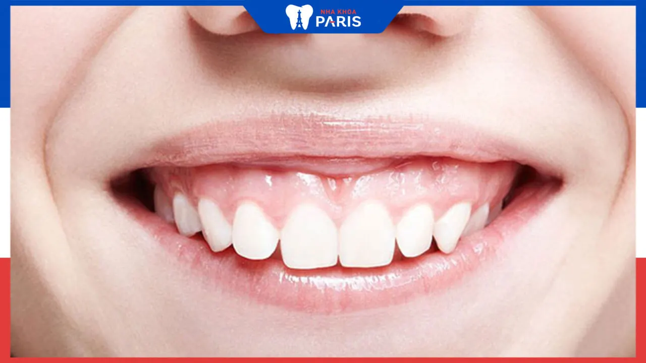 Điều trị cười hở lợi bao nhiêu tiền? Điều gì chi phối tới mức giá?