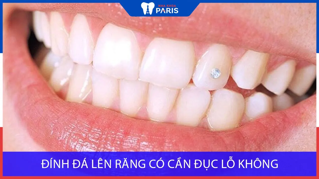Bạn nên biết: Đính đá lên răng có cần đục lỗ không?