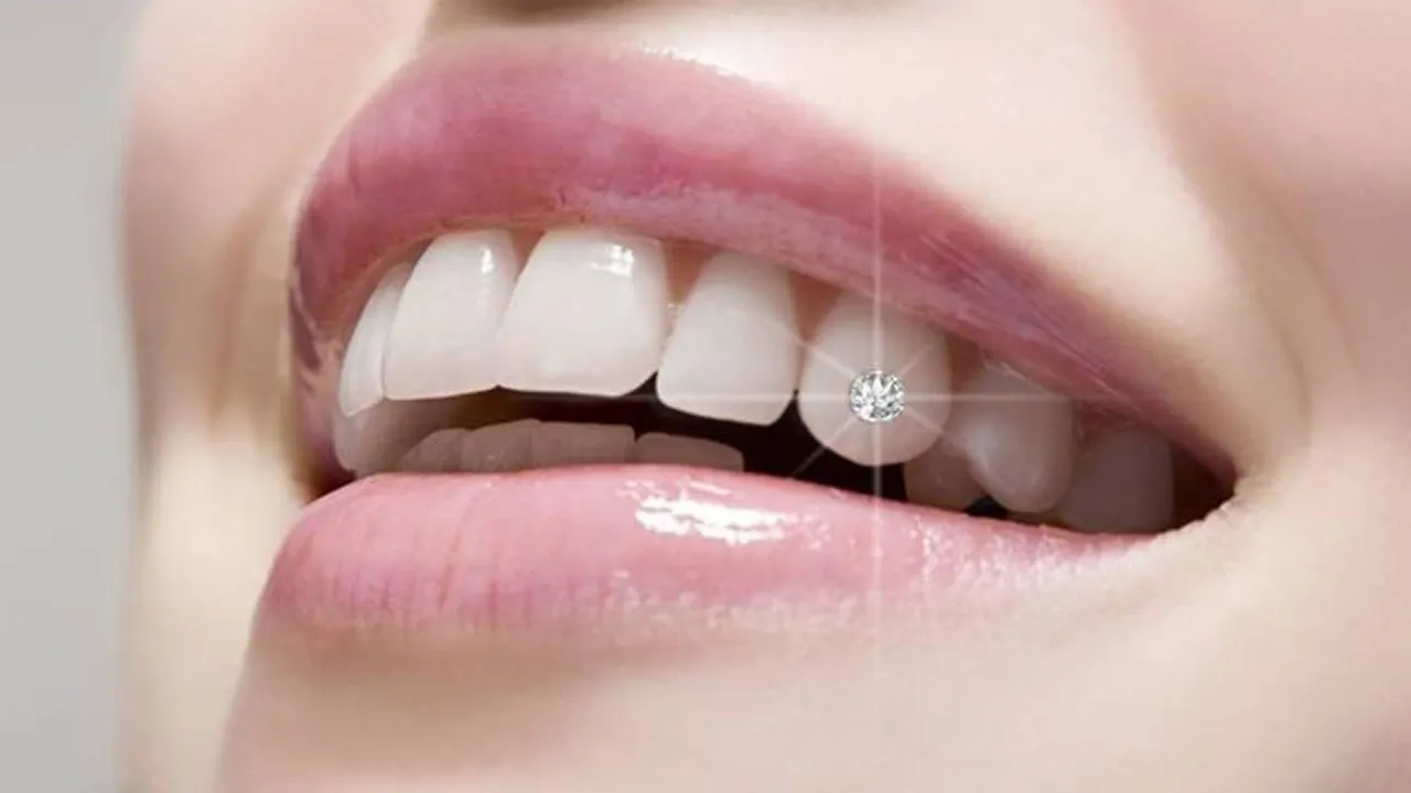 Đính đá vào răng có đau không? Công nghệ đính đá răng E.Las