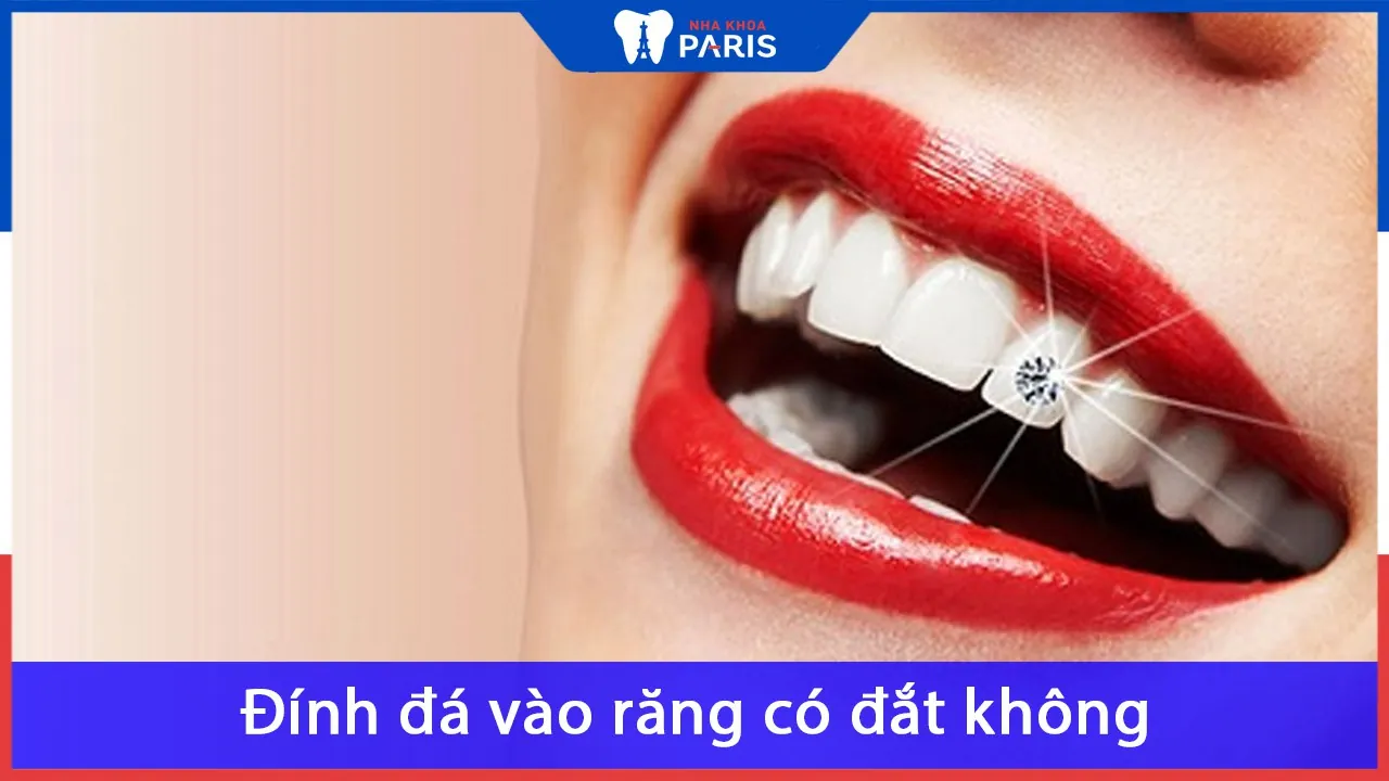 Đính đá vào răng có đắt không? [Xem ngay lời giải đáp]
