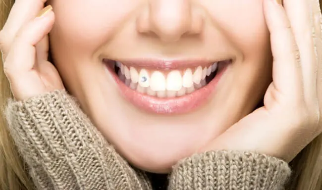 [Tư vấn] Răng bị mòn men có đính đá được không?