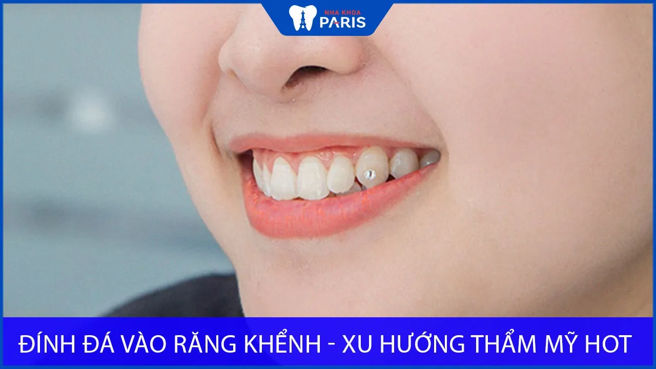 Đính đá vào răng khểnh – Xu hướng thẩm mỹ hot