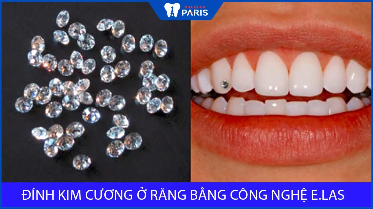 Đính kim cương ở răng bằng công nghệ E.Las có gì đặc biệt?