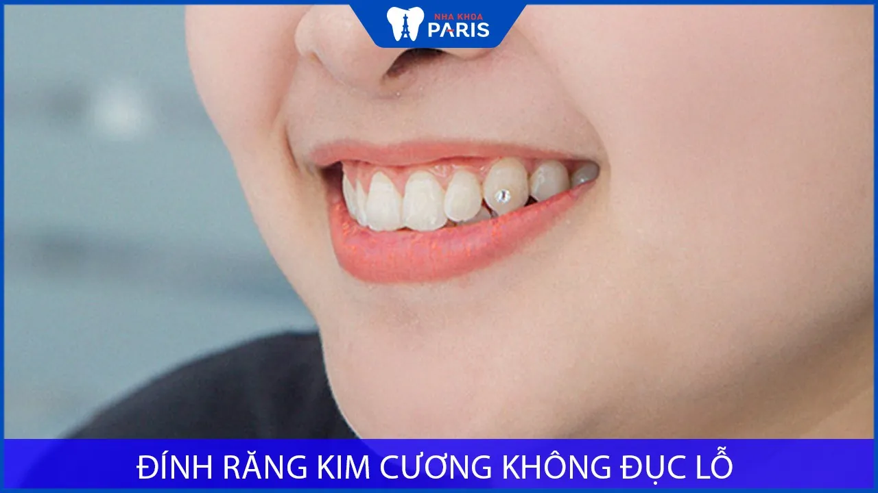 Phương pháp nào đính răng kim cương không đục lỗ?