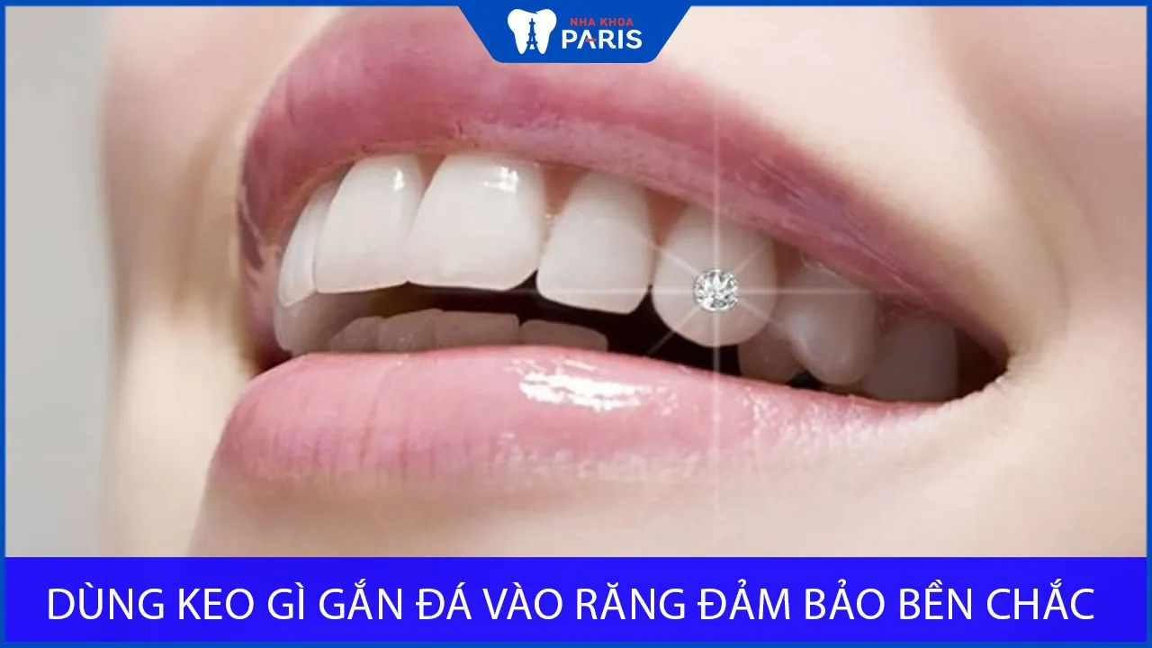 Dùng keo gì gắn đá vào răng đảm bảo BỀN CHẮC- AN TOÀN 100%