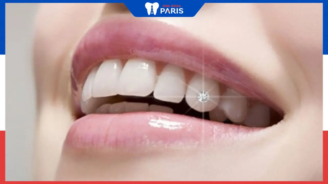 Gắn đá vào răng khểnh – Xu hướng mới, khẳng định cá tính
