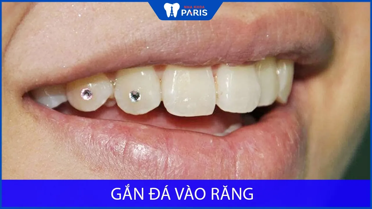 Gắn đá vào răng không cần khoan an toàn, bền đẹp, không đau