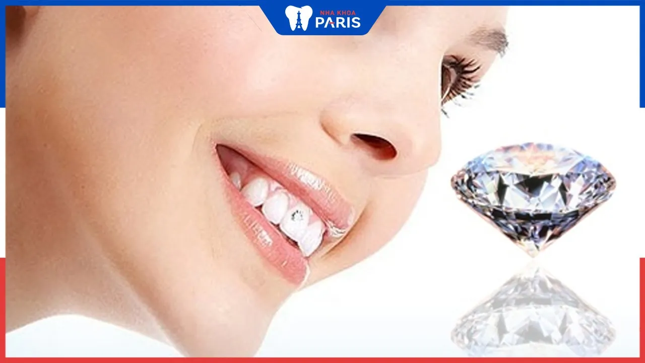 Gắn kim cương lên răng có đắt không thưa nha sỹ?