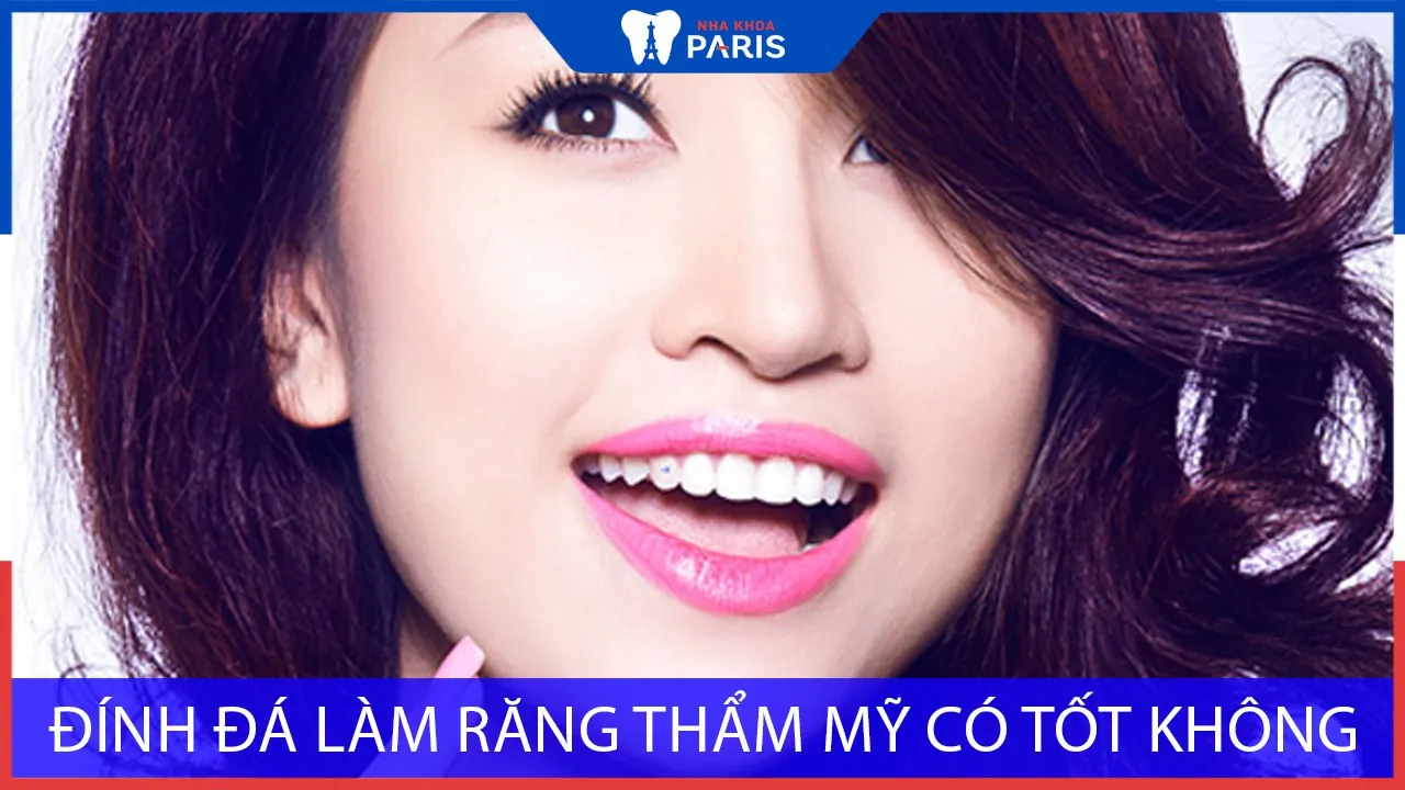 Giải đáp: Đính đá làm răng thẩm mỹ có tốt không?