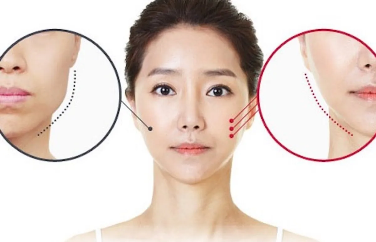 Phẫu thuật gọt hàm có đau không? Có nguy hiểm gì không