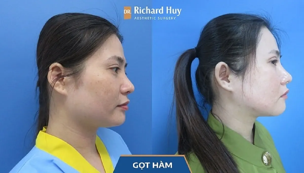 Gọt hàm nghỉ dưỡng bao lâu hết sưng và cách chăm sóc giúp vết thương nhanh lành