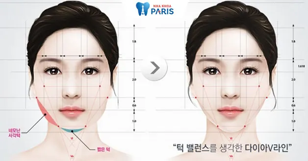 Tư vấn địa chỉ gọt hàm ở đâu đẹp và đảm bảo an toàn