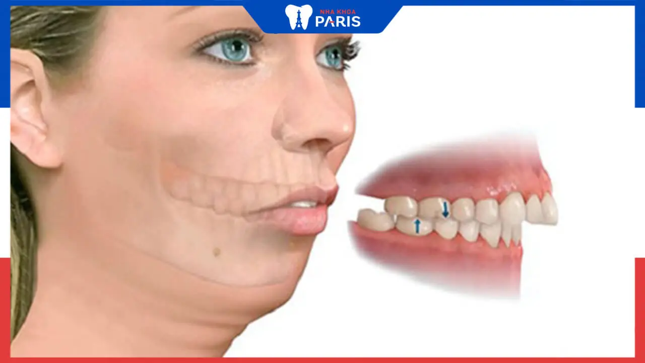 Phẫu thuật hàm vẩu và những điều quan trọng không thể bỏ qua
