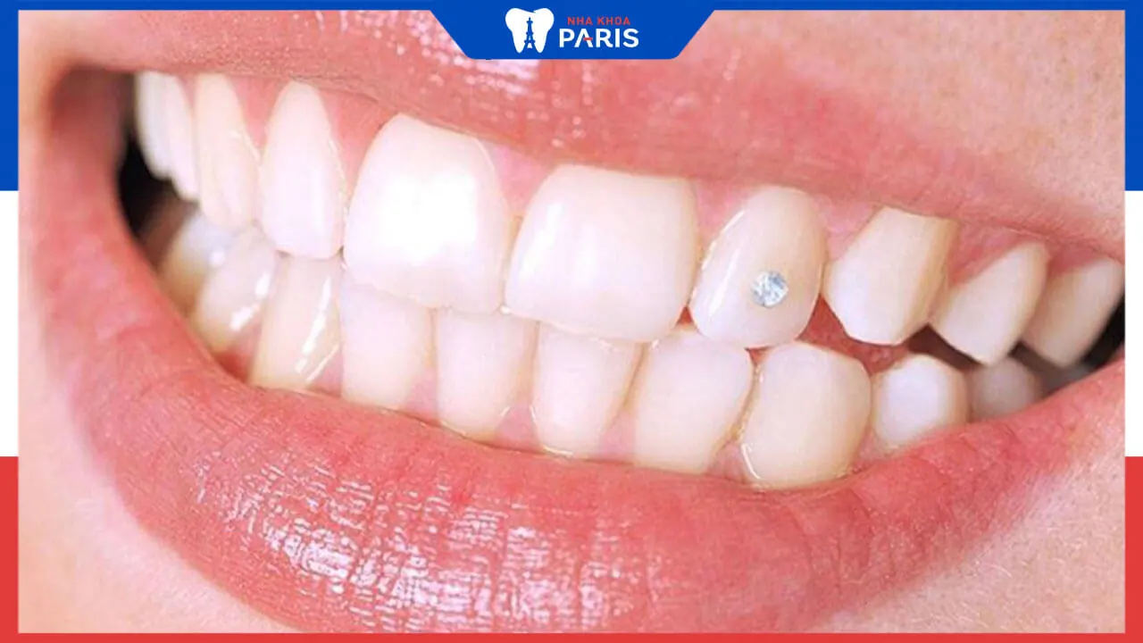 Kim cương nhân tạo gắn răng và những loại được ưa chuộng