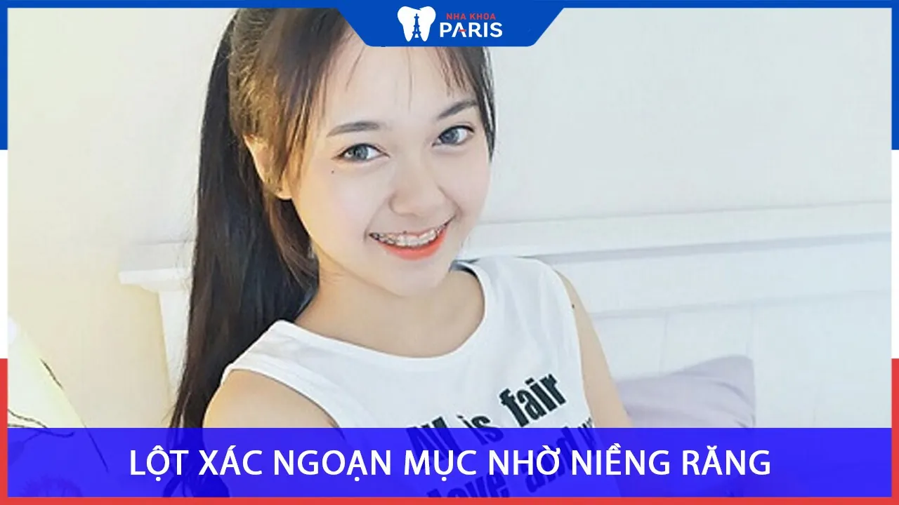 Hot girl lột xác ngoạn mục nhờ niềng răng chỉnh nha