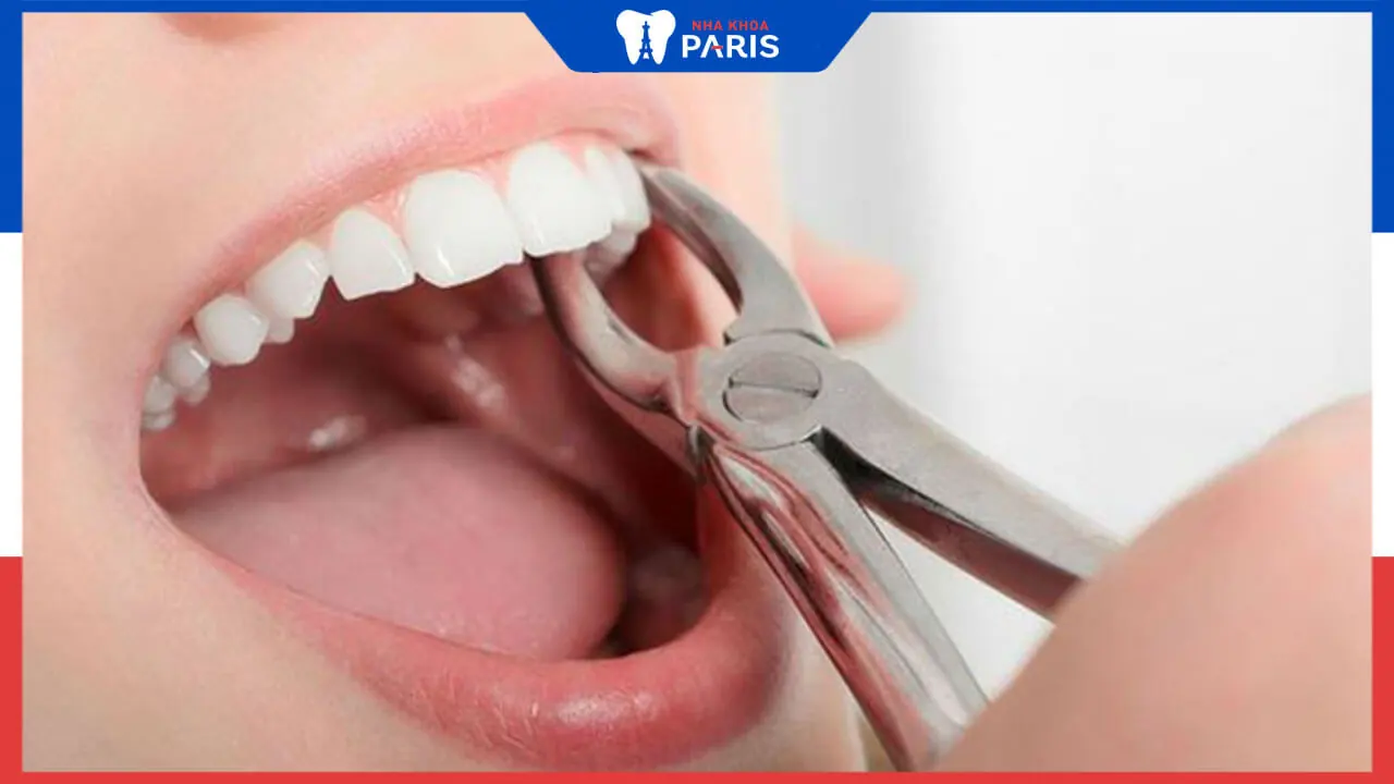 Nhổ răng có giảm tuổi thọ, trí nhớ hay trọng lượng cơ thể không?