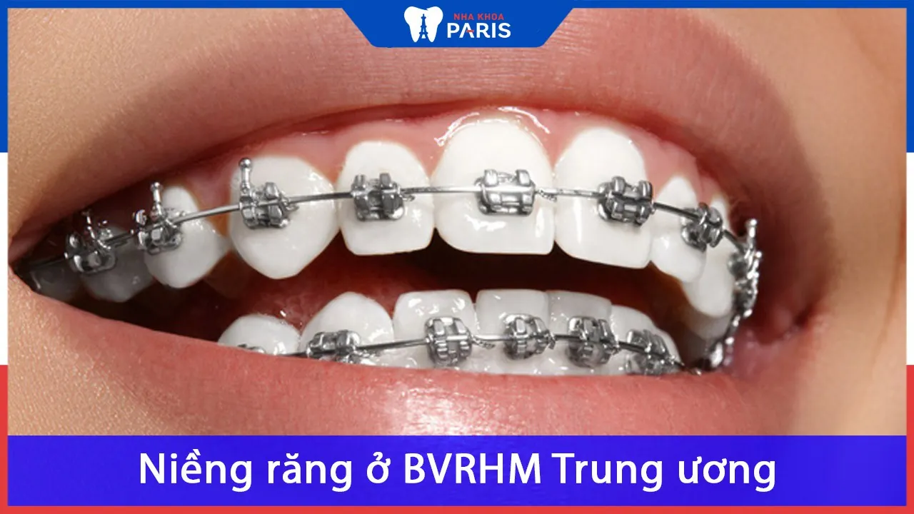 Niềng răng ở bệnh viện răng hàm mặt Trung ương tốt không?