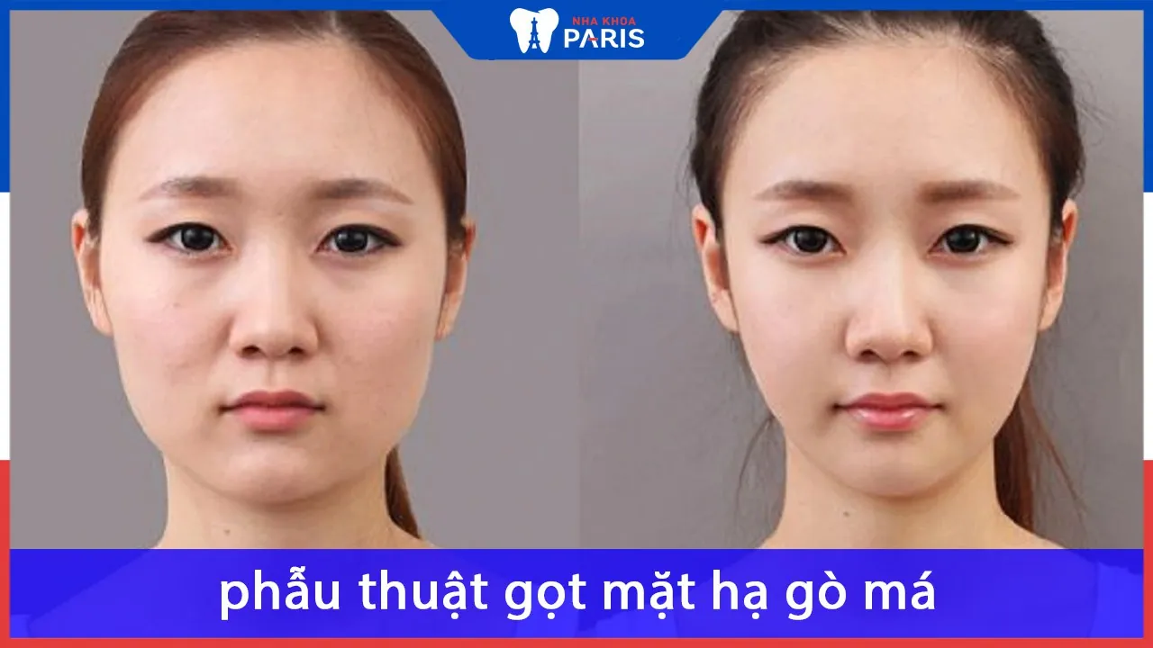 Những điều cần biết về phẫu thuật gọt mặt hạ gò má