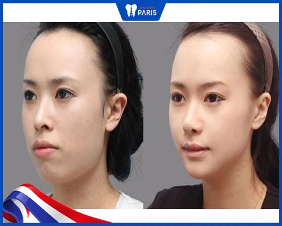 Phẫu thuật hàm bao lâu hết sưng? 3 cách giảm sưng siêu hiệu quả