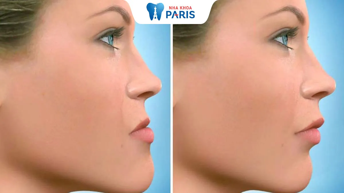 Mặt gãy là gì? Phẫu thuật mặt gãy bao nhiêu tiền