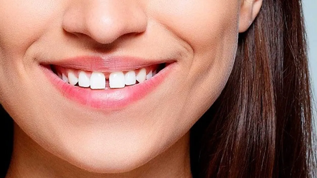 Răng cửa là răng nào? Cách khắc phục răng cửa thưa to