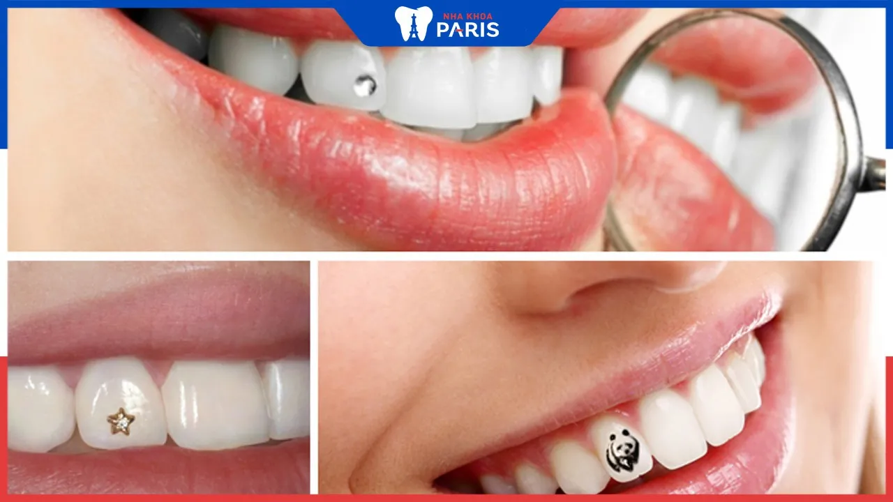 Răng khểnh đính đá có đảm bảo sáng bền đẹp không