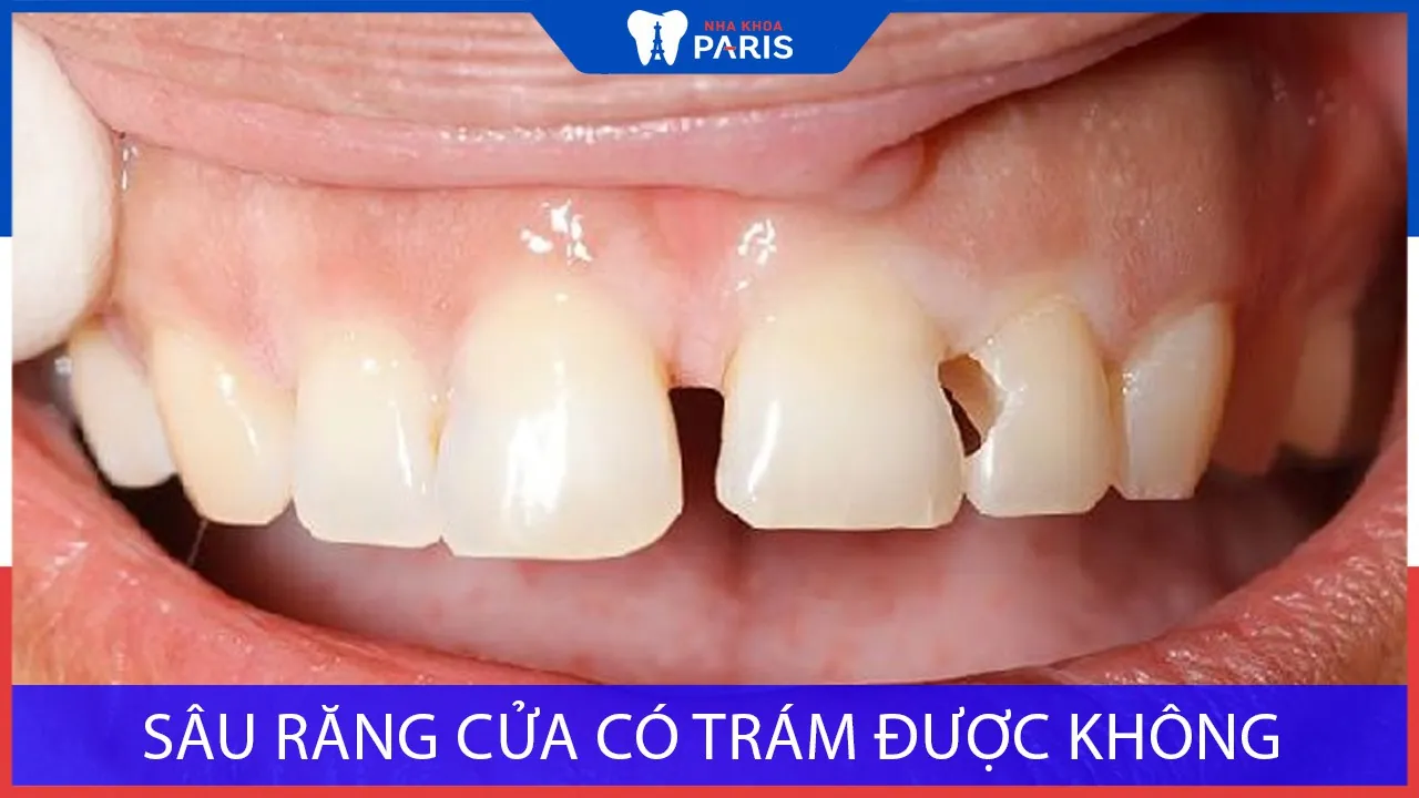 Sâu răng cửa có trám được không? Giá bao nhiêu là Chính Xác nhất?