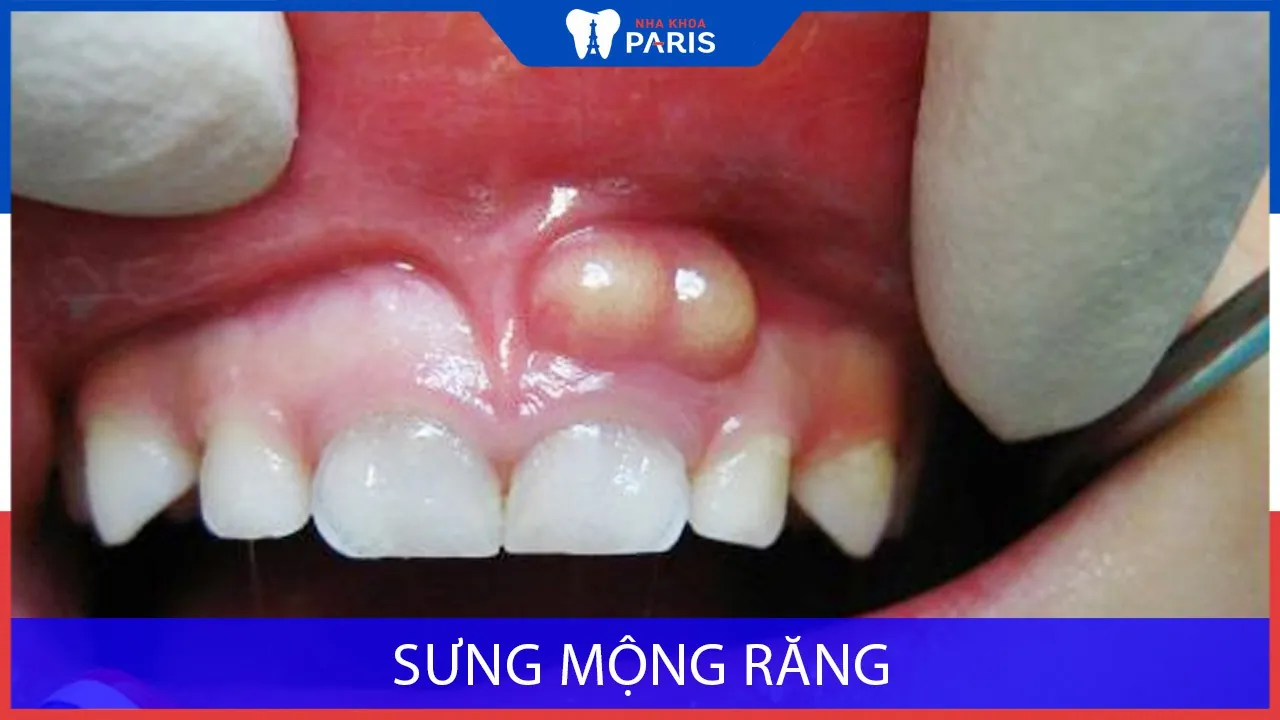 Sưng mộng răng: nguyên nhân và cách điều trị