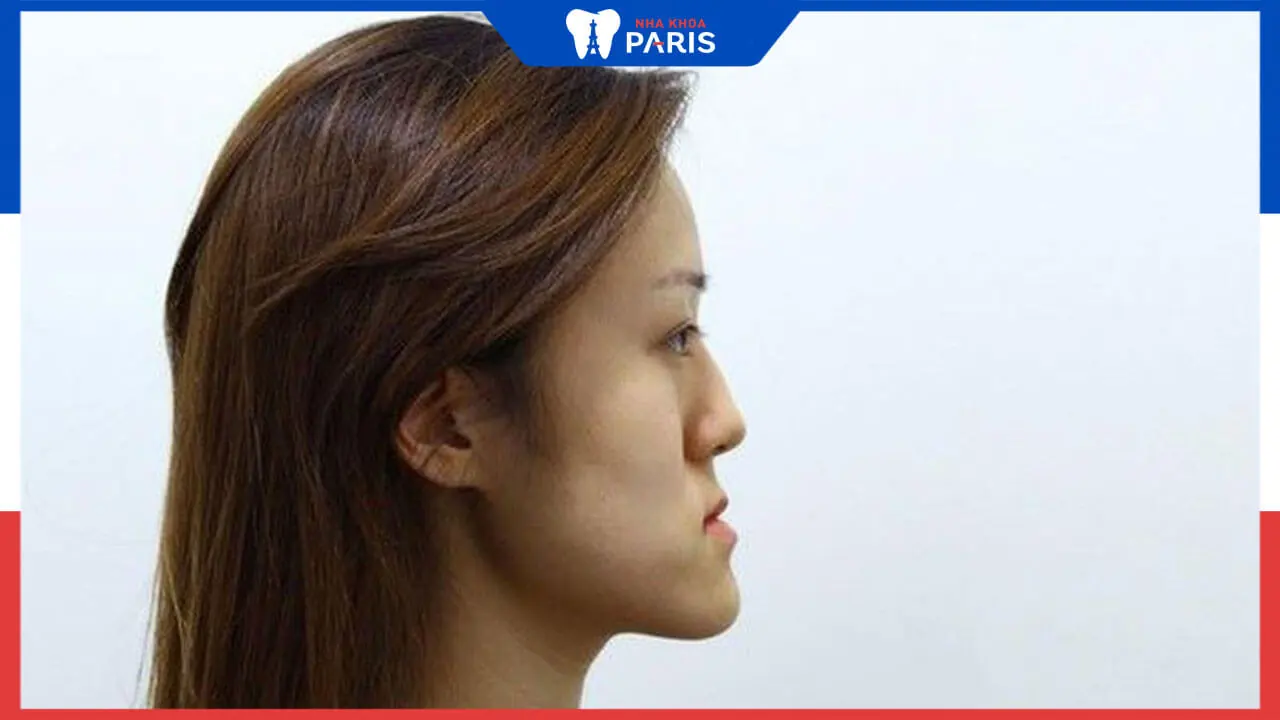 Chi phí phẫu thuật mặt lưỡi cày cần bao nhiêu?