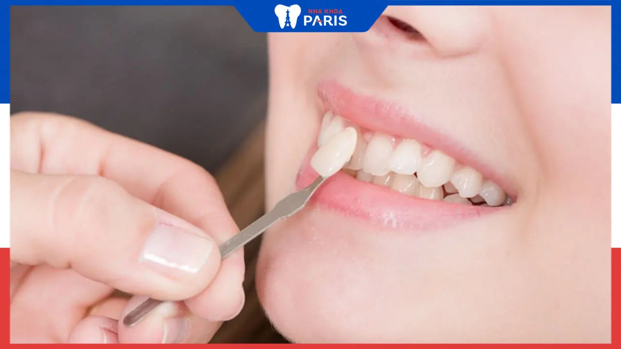 Dán răng sứ loại nào tốt nhất? Bí quyết chọn mặt dán sứ