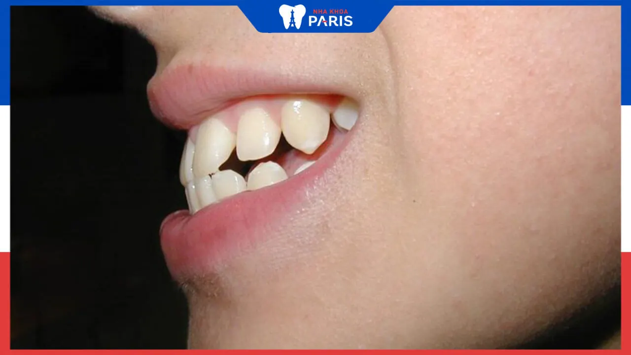 Phẫu thuật hàm hô nhẹ là gì? những lưu ý khi phẫu thuật
