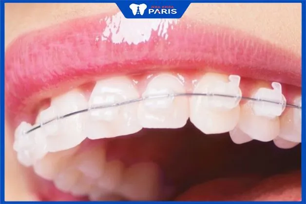 Niềng răng mắc cài sứ có mấy loại? Giá bao nhiêu? Niềng trong bao lâu?
