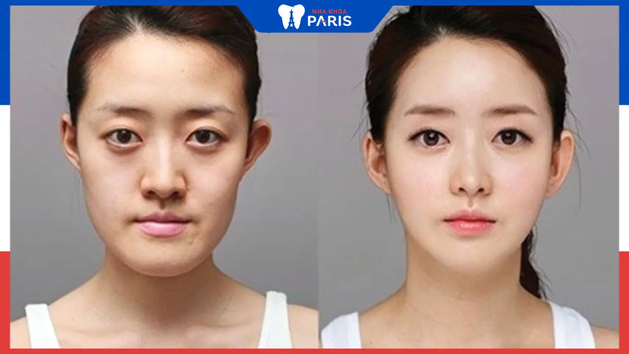 Phẫu thuật cắt xương quai hàm có nguy hiểm nào không