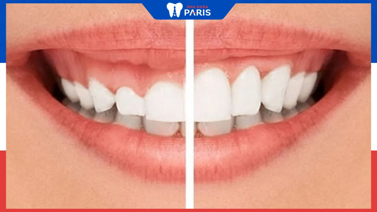 Phẫu thuật cười hở lợi có nguy hiểm không? Bác sĩ tư vấn