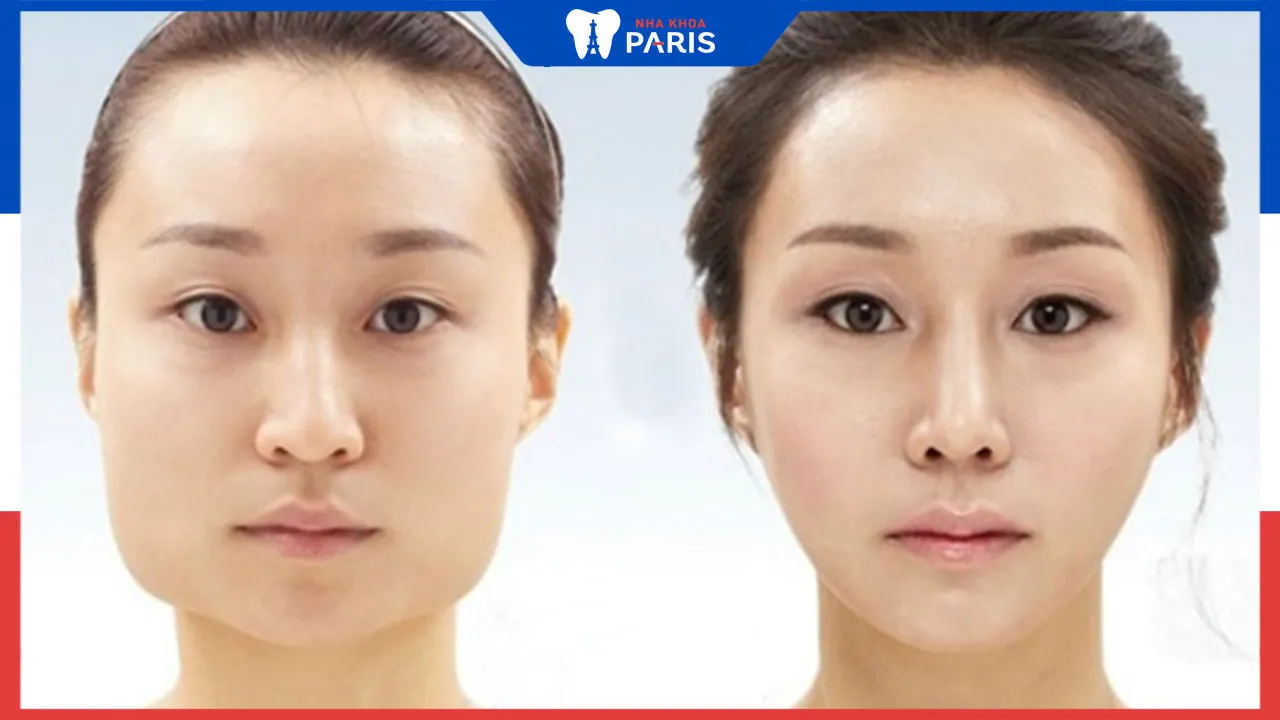 Phẫu thuật hàm vuông có nguy hiểm không?