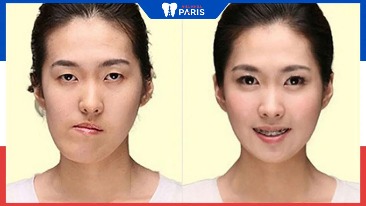 Tìm hiểu về phương pháp phẫu thuật mặt lệch