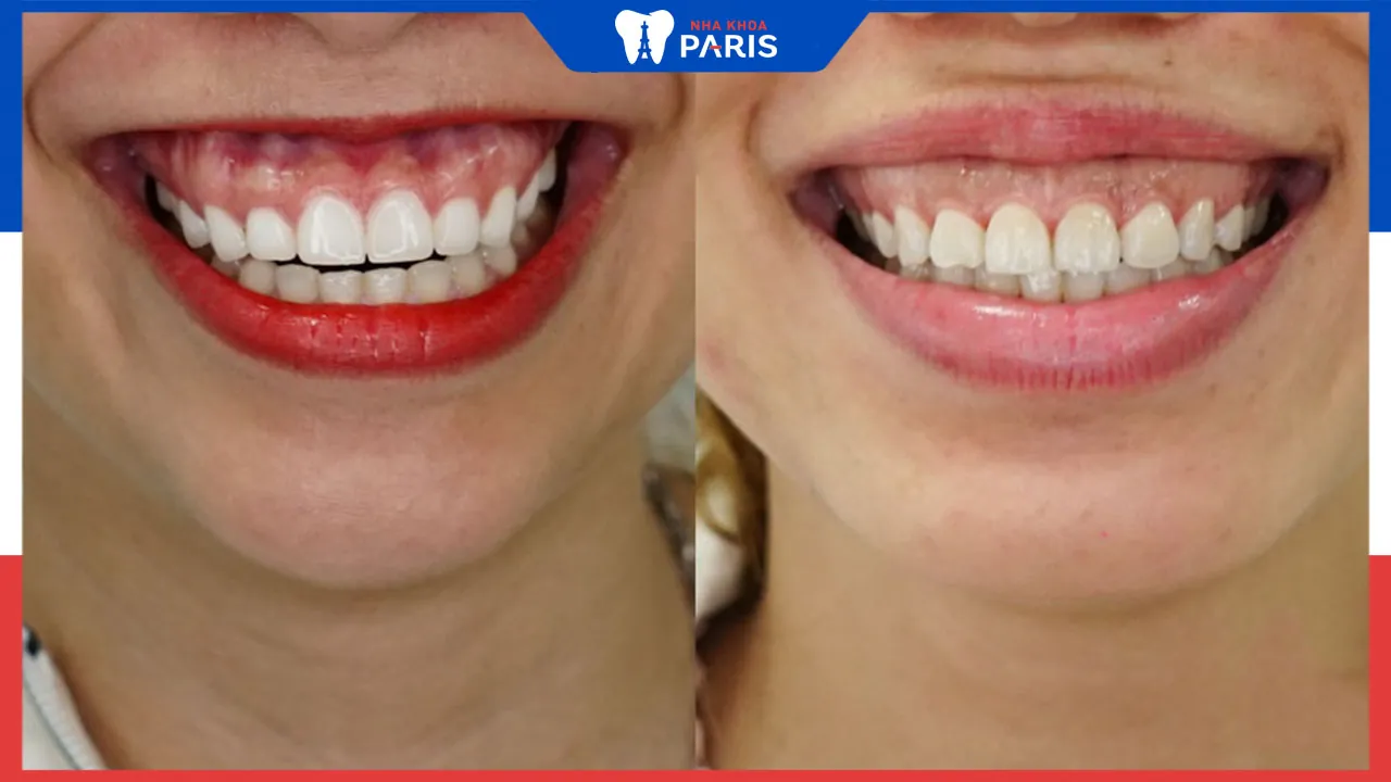 Phẫu thuật thẩm mỹ cười hở lợi như thế nào?