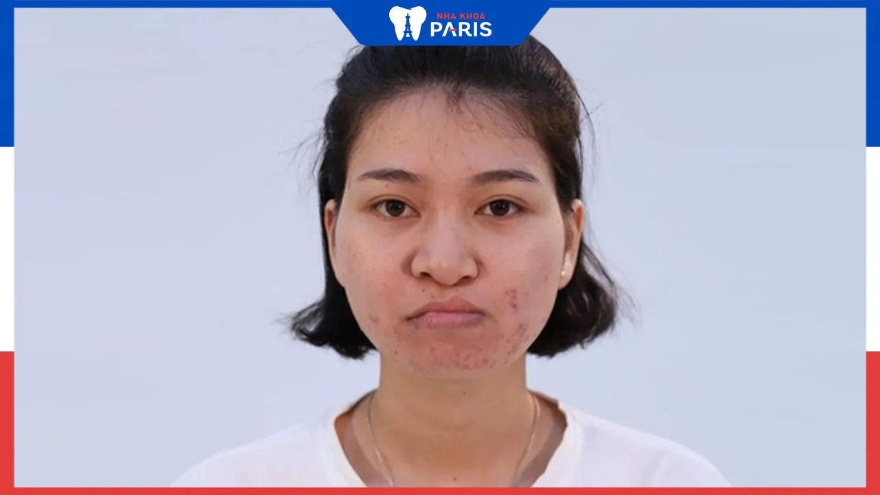 Những điều cần biết về chỉnh mũi hở hàm ếch 
