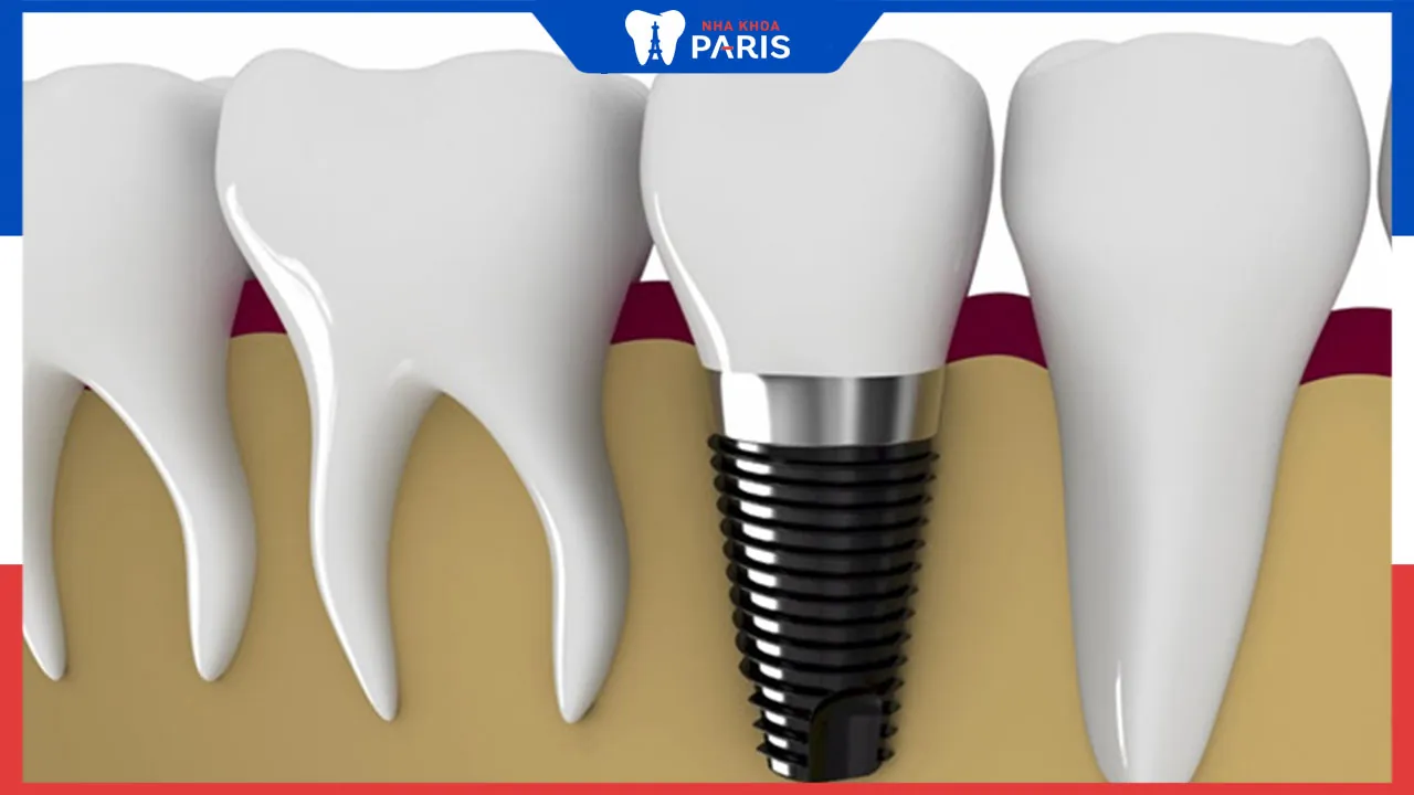 Cấy ghép răng Implant mất bao nhiêu tiền, có đắt không?